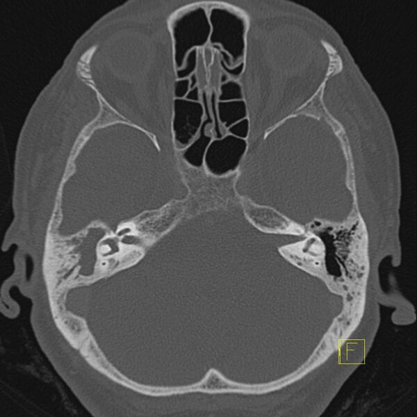 File:Cholesteatomatous chronic otitis (Radiopaedia 14993-14911 Axial bone window 8).JPEG