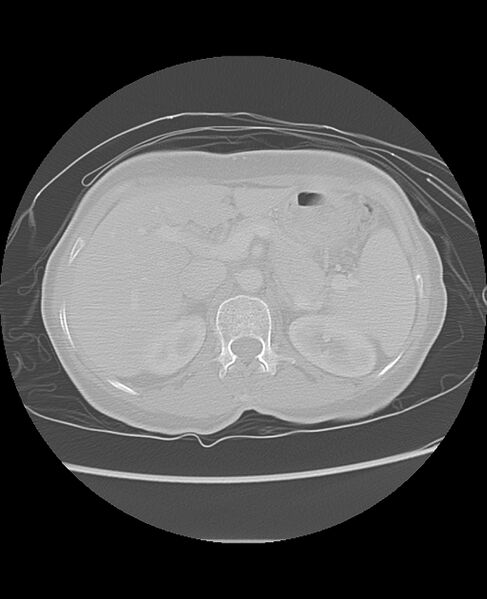 File:Chondrosarcoma (Radiopaedia 79427-92532 Axial lung window 58).jpg