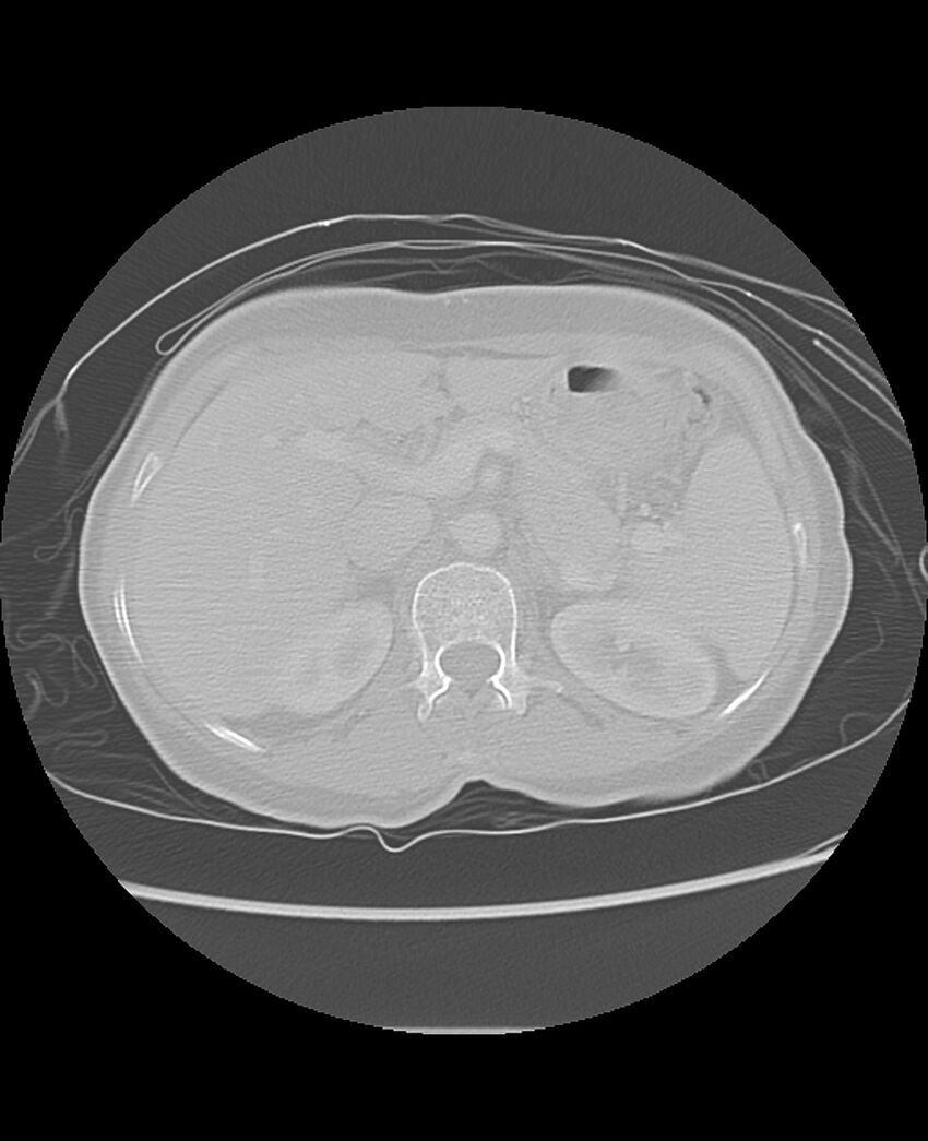 Chondrosarcoma (Radiopaedia 79427-92532 Axial lung window 58).jpg