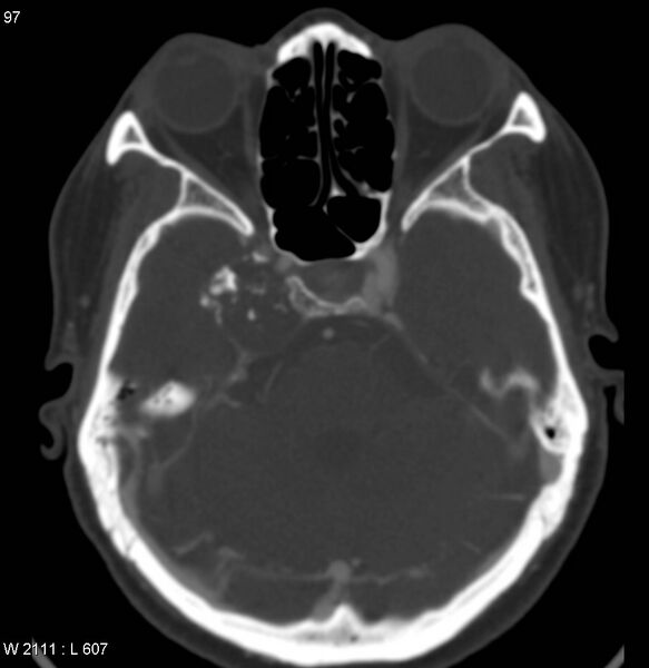 File:Chondrosarcoma - sphenoid wing (Radiopaedia 5421-7174 Axial bone window 3).jpg