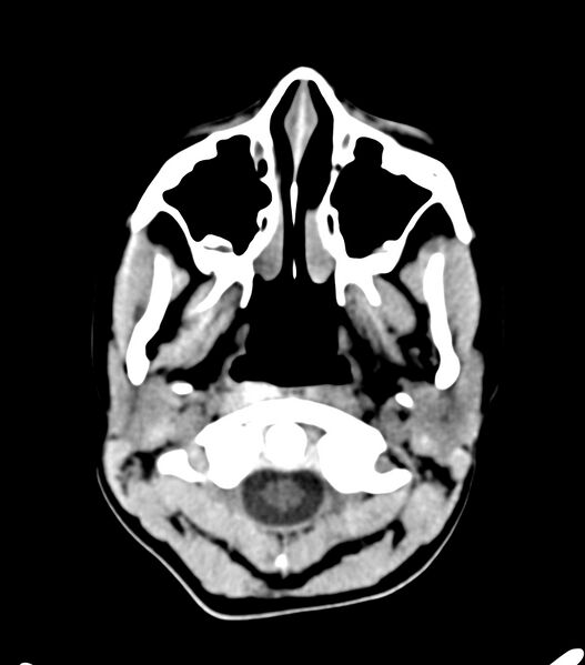 File:Choroid plexus carcinoma (Radiopaedia 91013-108552 Axial non-contrast 3).jpg