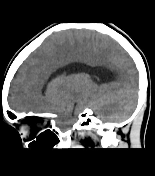 File:Choroid plexus carcinoma (Radiopaedia 91013-108552 B 27).jpg