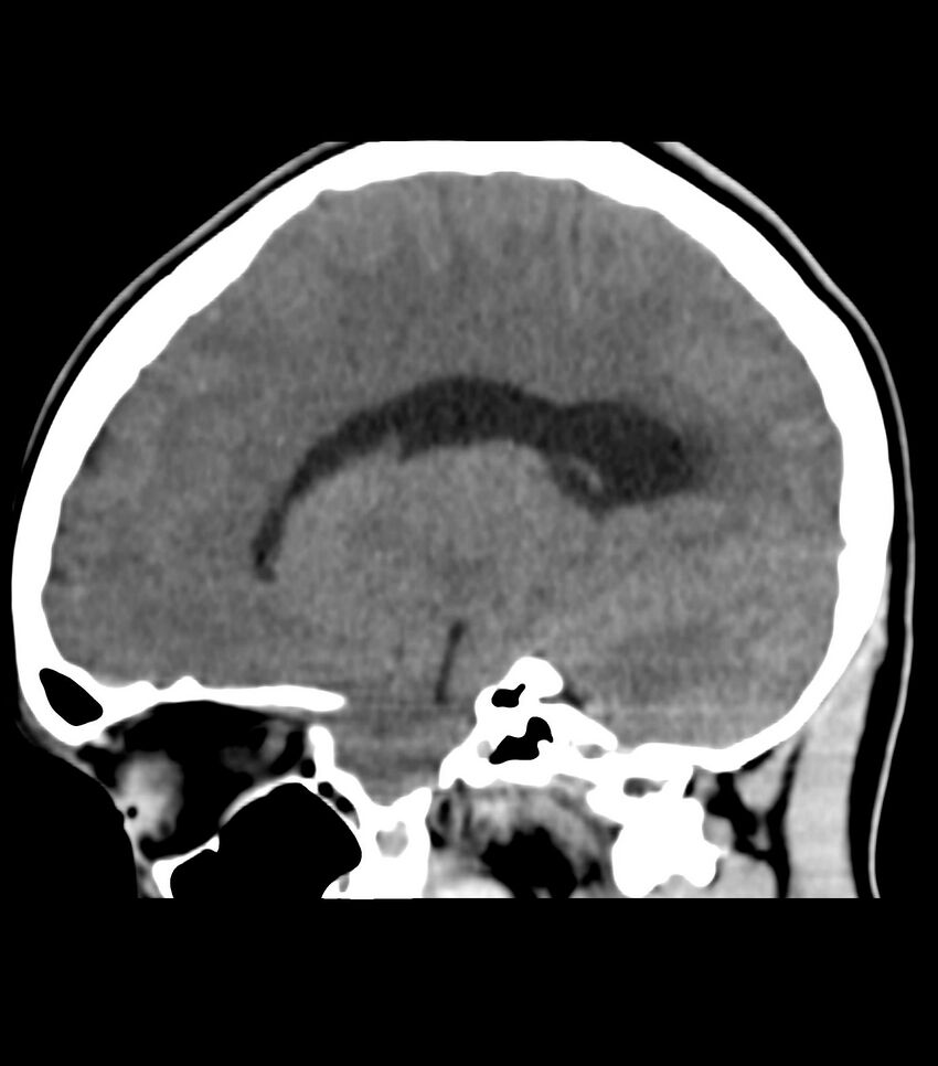 Choroid plexus carcinoma (Radiopaedia 91013-108552 B 27).jpg