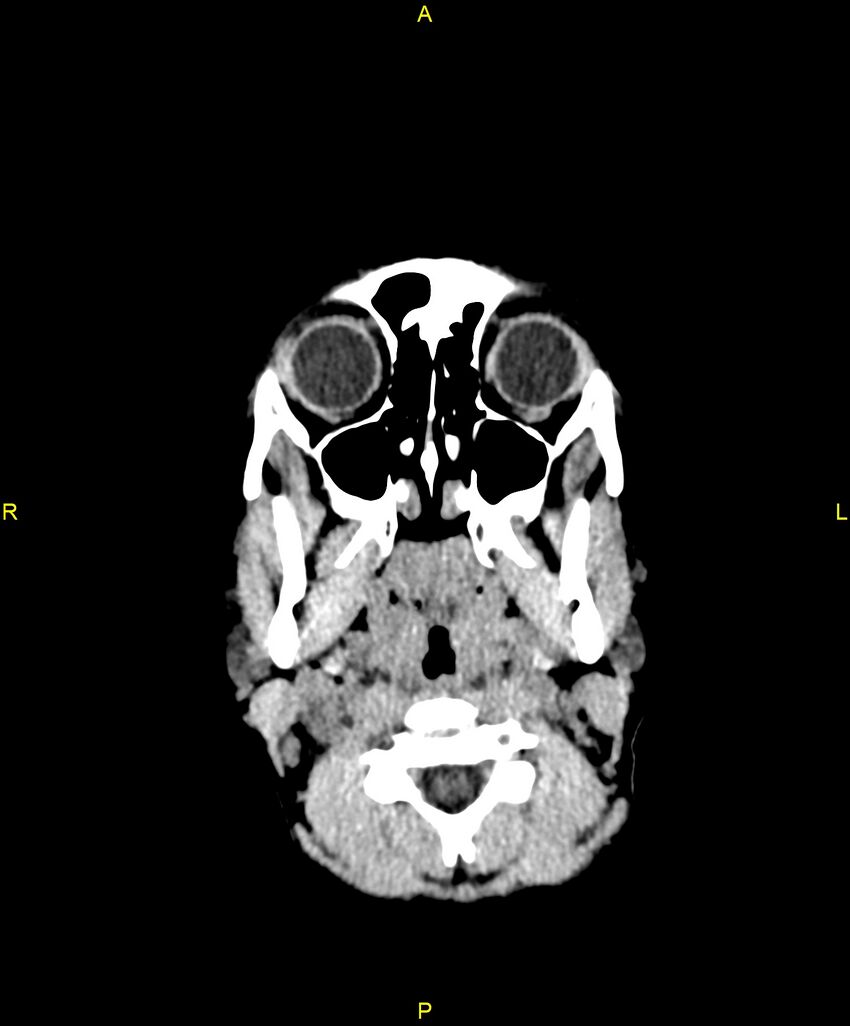 Choroidal fissure cyst (Radiopaedia 89481-106465 Axial non-contrast 4).jpg