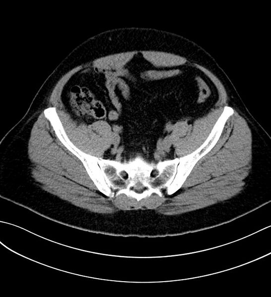 File:Chromophobe renal cell carcinoma (Radiopaedia 84286-99573 Axial non-contrast 49).jpg