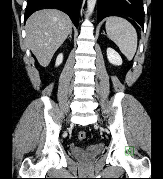 File:Chromophobe renal cell carcinoma (Radiopaedia 84286-99573 H 124).jpg