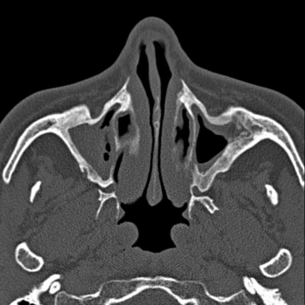 File:Chronic maxillary sinusitis (Radiopaedia 27879-28116 Axial bone window 16).jpg