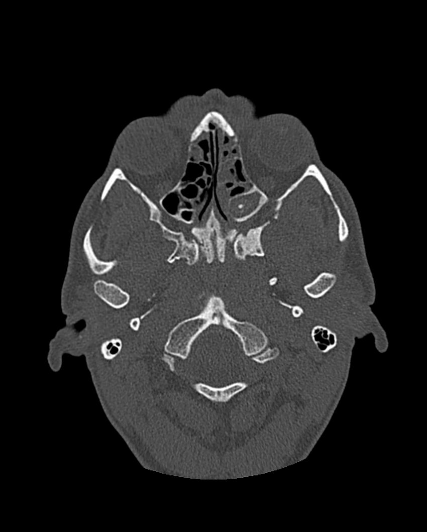 Chronic maxillary sinusitis caused by a foreign body (Radiopaedia 58521-65676 Axial bone window 182).jpg