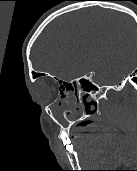 File:Chronic maxillary sinusitis caused by a foreign body (Radiopaedia 58521-65676 Sagittal bone window 5).jpg
