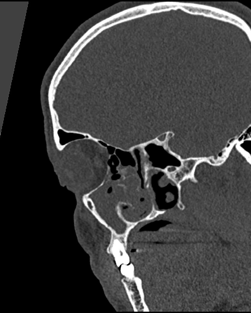 Chronic maxillary sinusitis caused by a foreign body (Radiopaedia 58521-65676 Sagittal bone window 5).jpg