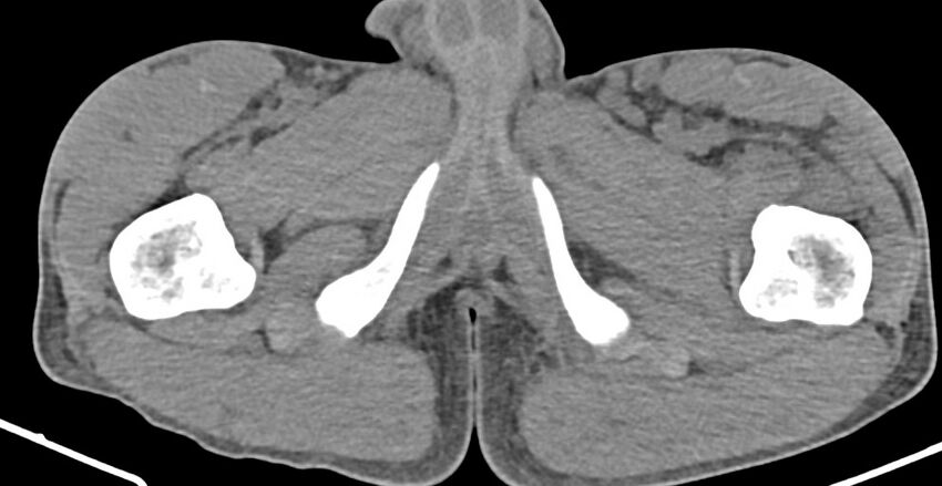 Chronic osteomyelitis (with sequestrum) (Radiopaedia 74813-85822 D 56).jpg