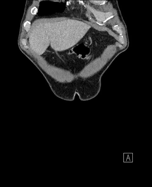 File:Closed loop small bowel obstruction - internal hernia (Radiopaedia 57806-64778 A 11).jpg