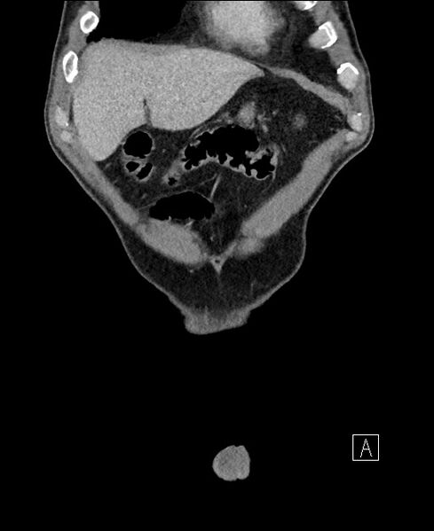 File:Closed loop small bowel obstruction - internal hernia (Radiopaedia 57806-64778 A 15).jpg