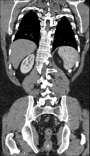File:Coarctation of the aorta (Radiopaedia 74632-88521 B 194).jpg