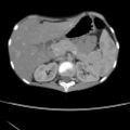 Colocolic fistula - Crohn disease (Radiopaedia 57063-63955 A 19).jpg