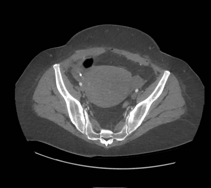 File:Colonic pseudo-obstruction (Radiopaedia 79752-92980 A 155).png