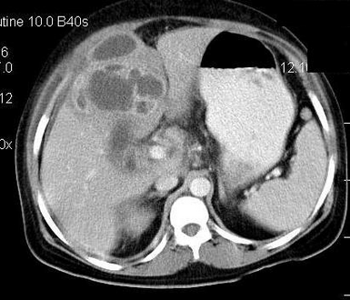 Contrast enhanced computed tomography of the abdomen is showing gall bladder empyema with perforation and formation of liver abscess.