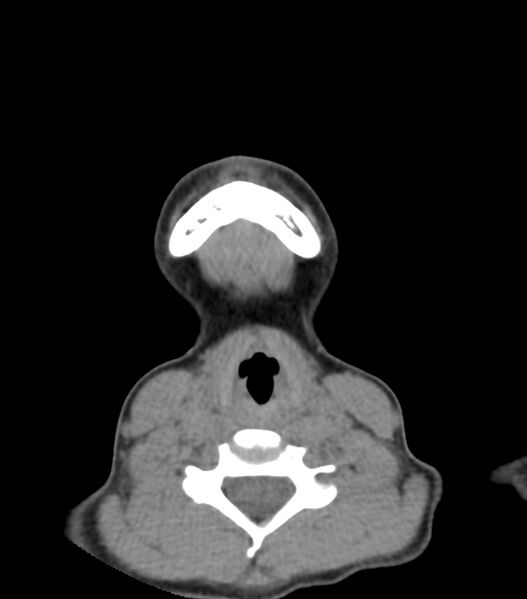 File:Nasoorbitoethmoid fracture (Radiopaedia 90044-107205 Axial non-contrast 28).jpg
