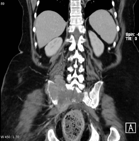 File:Nerve sheath tumor - malignant - sacrum (Radiopaedia 5219-6987 B 12).jpg