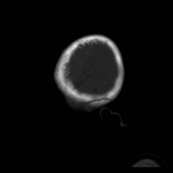 File:Neuroblastoma with skull metastases (Radiopaedia 30326-30958 Sagittal bone window 41).jpg