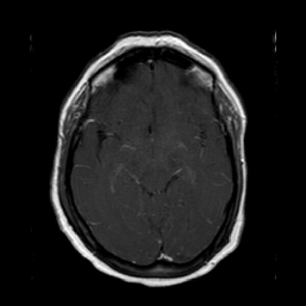 File:Neurofibromatosis type 2 (Radiopaedia 67470-76871 Axial T1 C+ 11).jpg