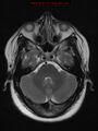 Neuroglial cyst (Radiopaedia 10713-11184 Axial T2 17).jpg