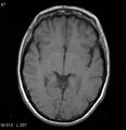 Neurosarcoidosis (Radiopaedia 10930-17204 Axial T1 9).jpg