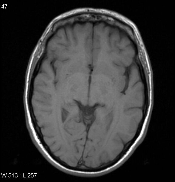 File:Neurosarcoidosis (Radiopaedia 10930-17204 Axial T1 9).jpg