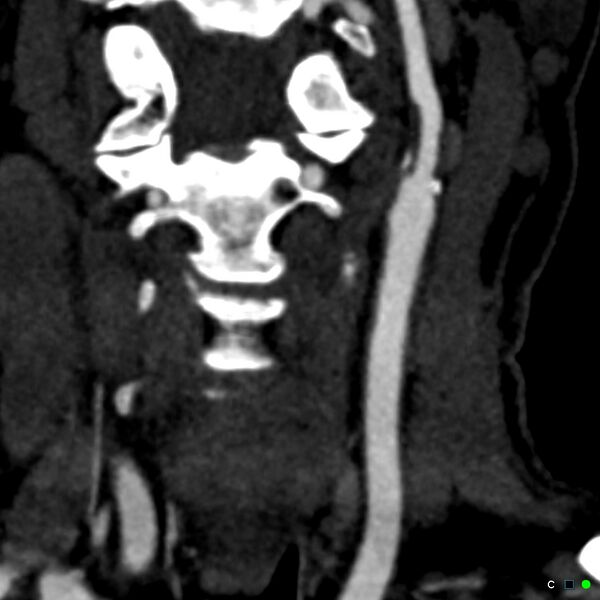 File:Non-occlusive intraluminal internal carotid artery thrombus (Radiopaedia 37751-39658 C 2).jpg