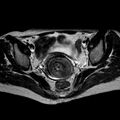 Non-puerperal uterine inversion (Radiopaedia 78343-90983 Axial T2 21).jpg