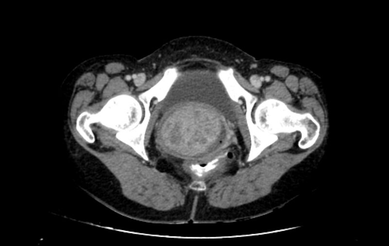 File:Non-puerperal uterine inversion (Radiopaedia 78343-91094 A 73).jpg