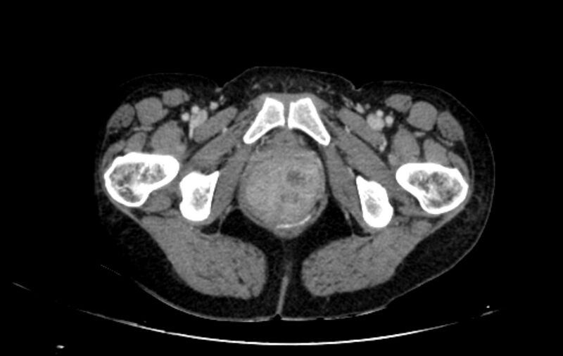 File:Non-puerperal uterine inversion (Radiopaedia 78343-91094 A 88).jpg