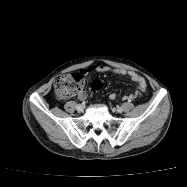 File:Non small-cell lung cancer (Radiopaedia 24467-24769 C+ delayed 98).jpg