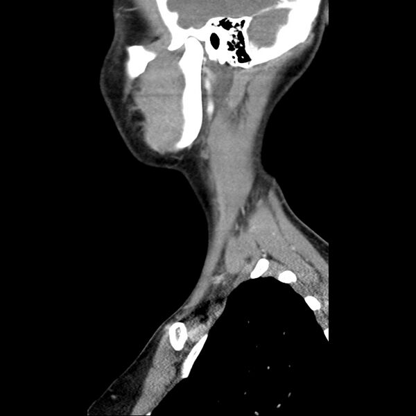 File:Normal CT of the neck (Radiopaedia 14575-14500 Sagittal C+ 11).jpg