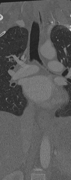 File:Normal CT thoracic spine (Radiopaedia 40181-42688 Coronal bone window 13).png