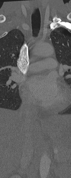 File:Normal CT thoracic spine (Radiopaedia 40181-42688 Coronal bone window 7).png
