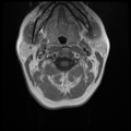 Normal cervical and thoracic spine MRI (Radiopaedia 35630-37156 Axial T1 C+ 27).png