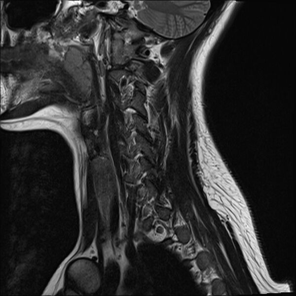 File:Normal trauma cervical spine MRI (Radiopaedia 32130-33071 Sagittal T2 1).jpg