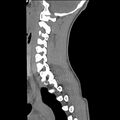 Normal trauma spine imaging (age 16) (Radiopaedia 45335-49358 C 27).jpg