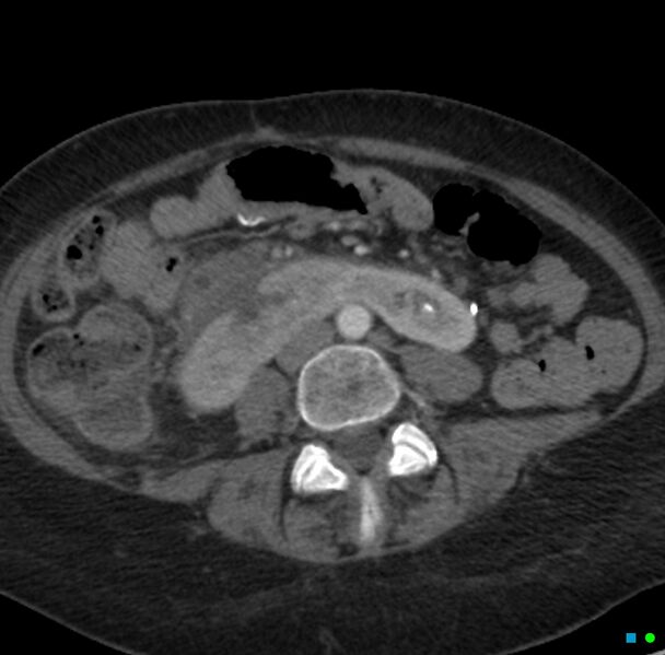 File:Obstructed infected horseshoe kidney (Radiopaedia 18116-17898 B 21).jpg