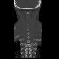 Occipital condyle fracture (Radiopaedia 31755-32691 Coronal bone window 30).jpg