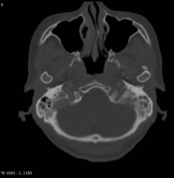 File:Occipital condyle metastasis - into mastoid (Radiopaedia 5424-7177 Axial bone window 6).jpg