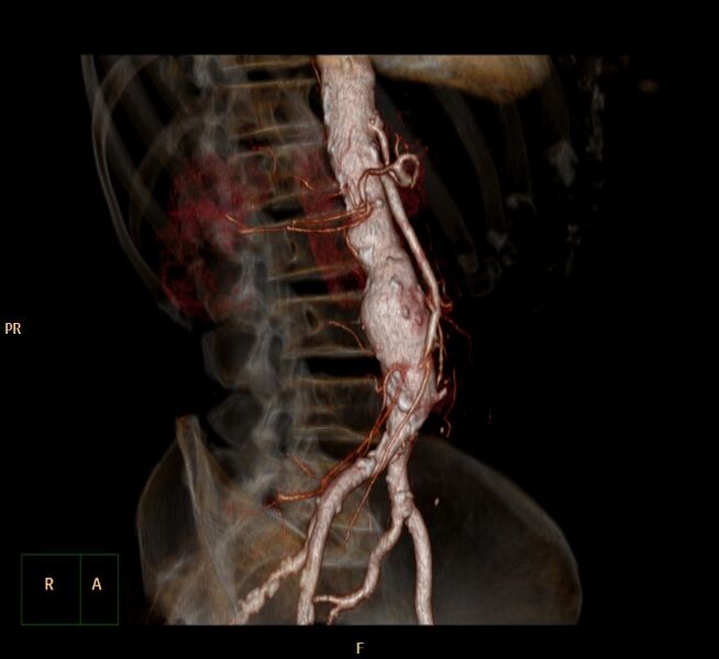 File:Abdominal aortic aneurysm (Radiopaedia 23703-23856 3D 5).jpg