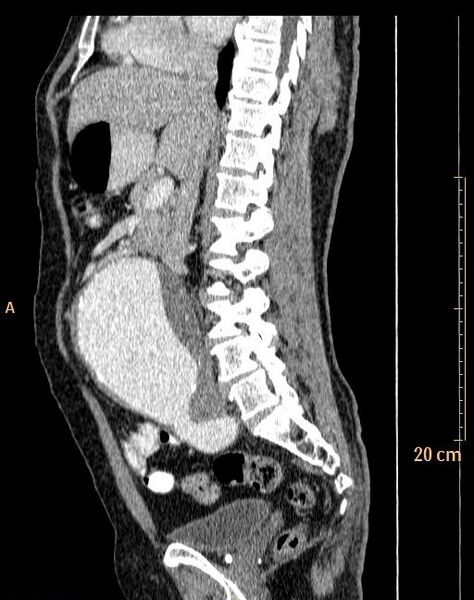 File:Abdominal aortic aneurysm (Radiopaedia 25985-26121 Sagittal C+ arterial phase 22).jpg