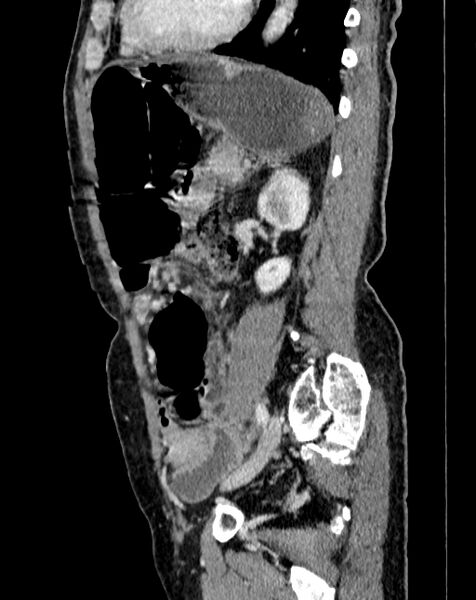File:Abdominal aortic aneurysm (Radiopaedia 83581-98689 Sagittal C+ portal venous phase 85).jpg