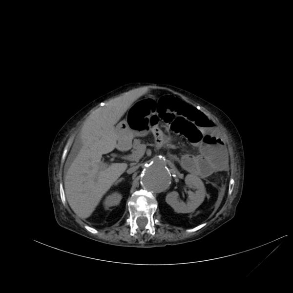 File:Abdominal aortic aneurysm - impending rupture (Radiopaedia 19233-19246 Axial non-contrast 44).jpg
