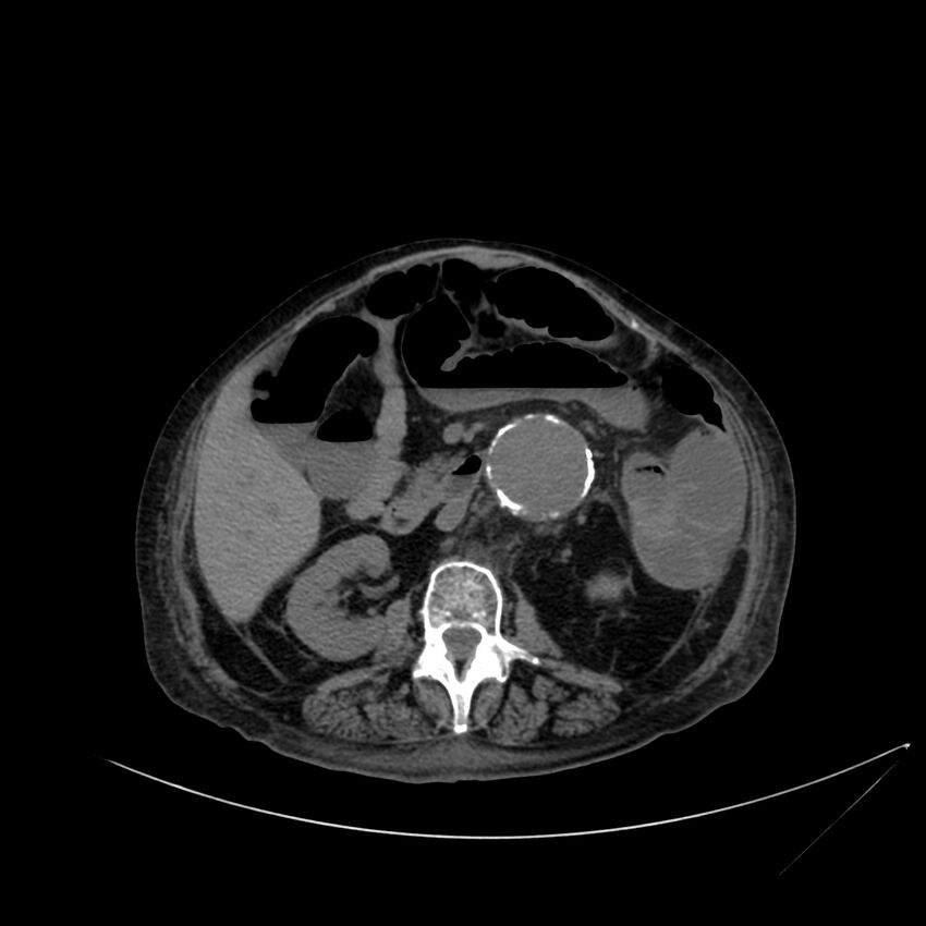Abdominal aortic aneurysm - impending rupture (Radiopaedia 19233-19246 Axial non-contrast 60).jpg
