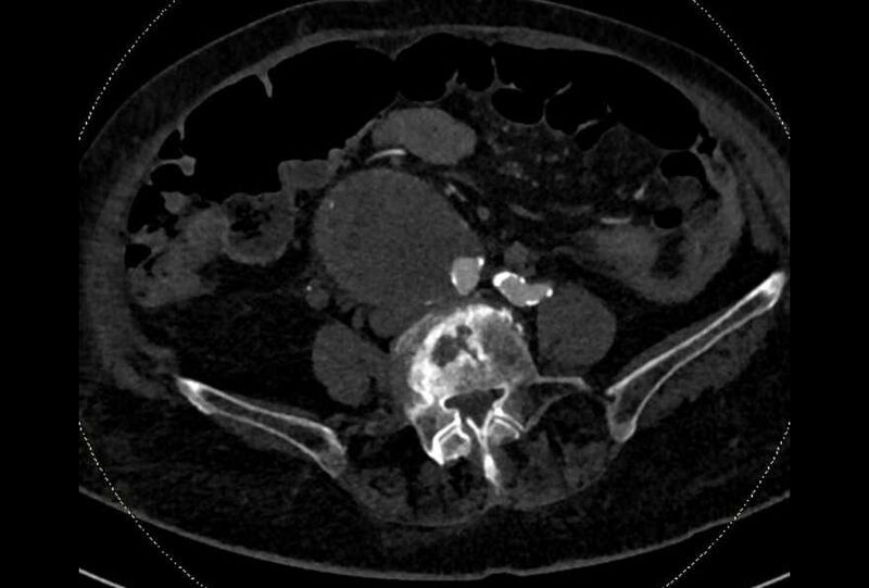File:Abdominal aortic aneurysm with thrombus fissuration (Radiopaedia 73192-83919 Axial C+ arterial phase 139).jpg