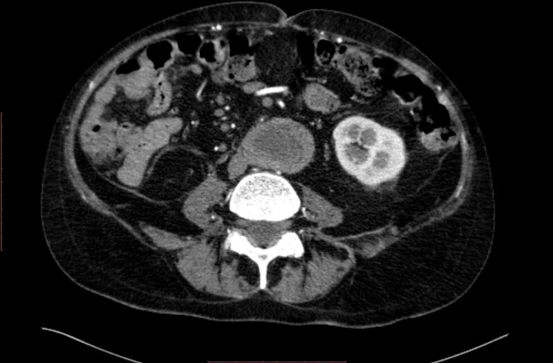 File:Abdominal aortic interposition tube graft and aneurysm thrombosis (Radiopaedia 71438-81857 Axial C+ arterial phase 105).jpg