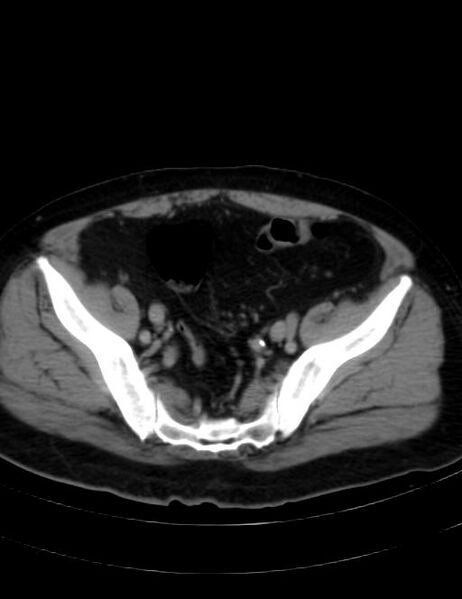 File:Abdominal lymphoma - with sandwich sign (Radiopaedia 53486-59492 Axial C+ portal venous phase 41).jpg